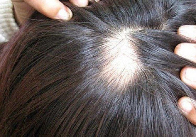 Ăn gì hỗ trợ mọc tóc ? bị rụng tóc thiếu chất gì