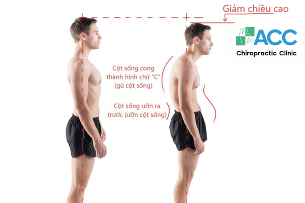 Cách chống gù lưng cho thanh niên, 7 bài tập chữa gù lưng không phải ai cũng biết